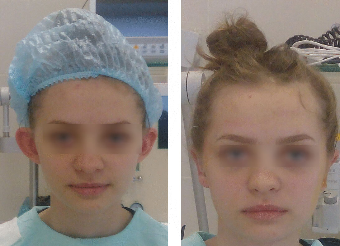 Отопластика в Эстемед фото До и После