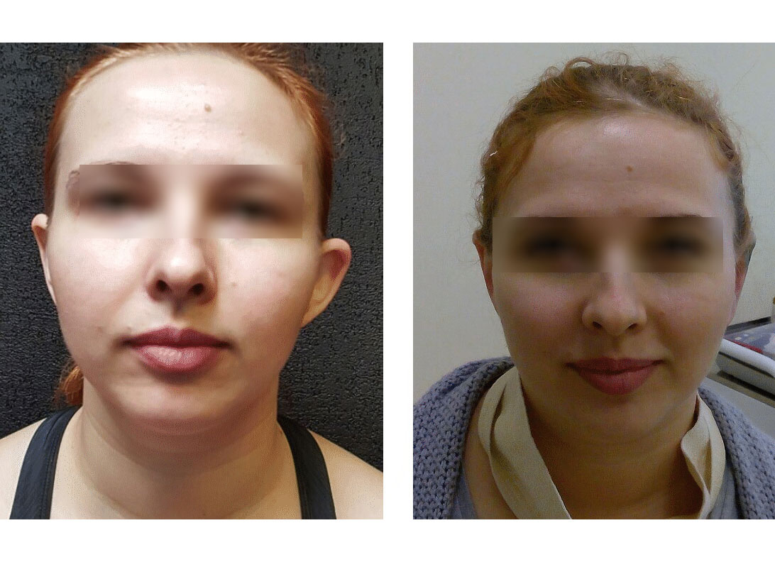 Пластика ушных раковин. Фото до и после