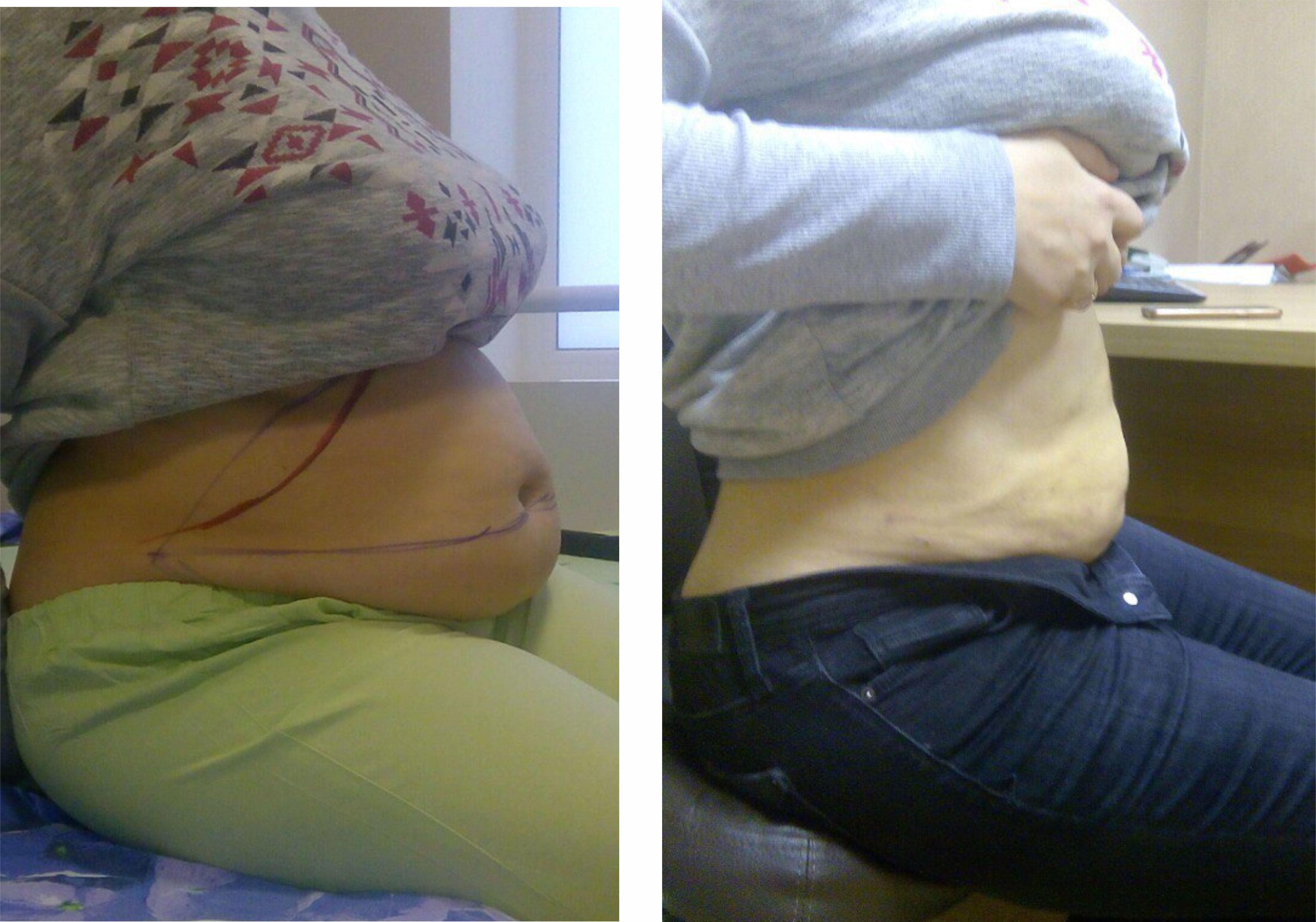 Фото до и после липосакции в Эстемед