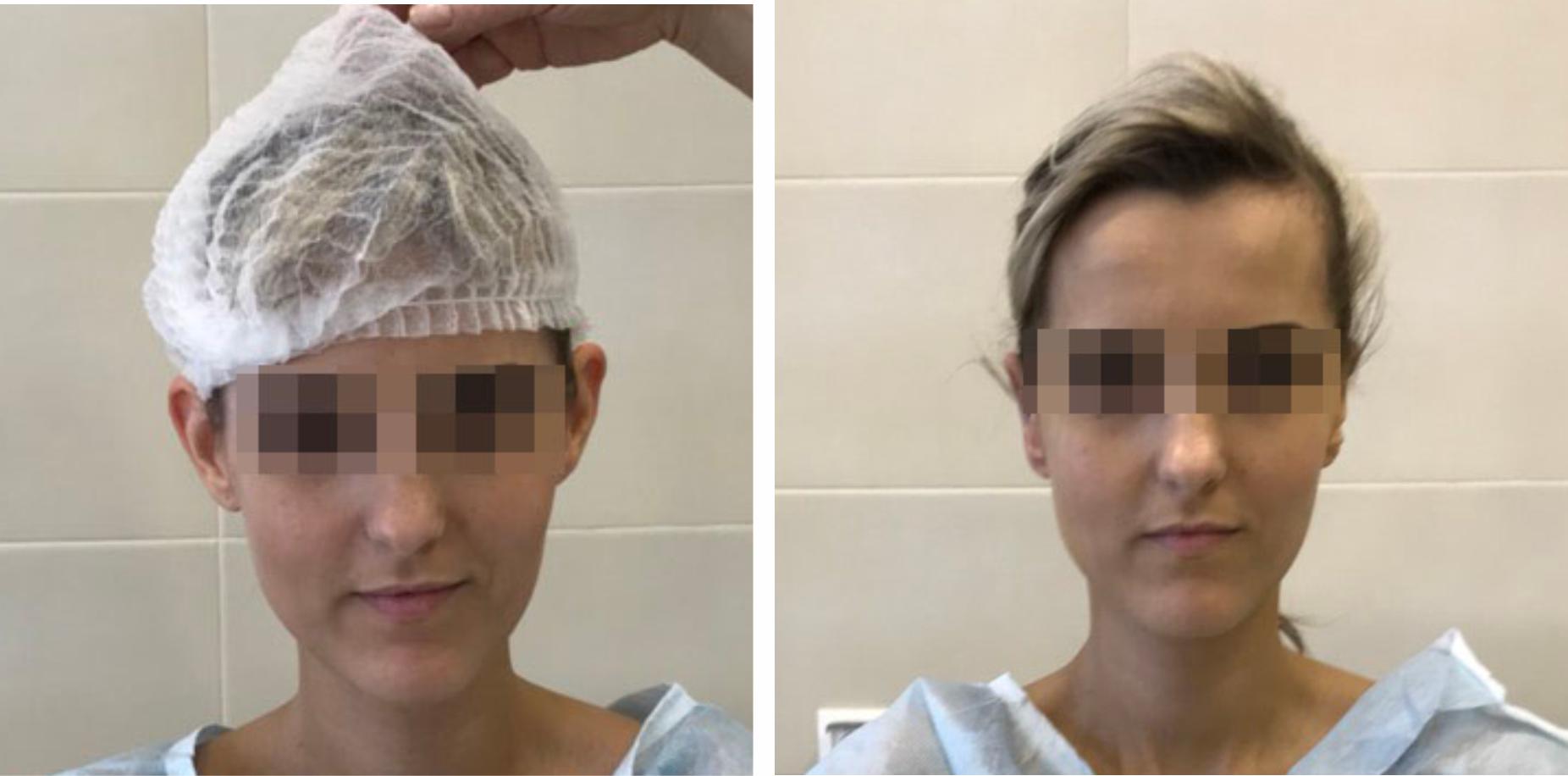 Коррекция лопоухости в Эстемед