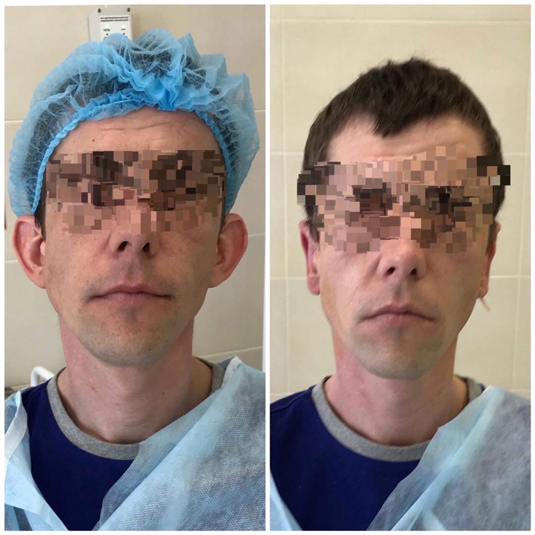 Фото До и После отопластики в Эстемед